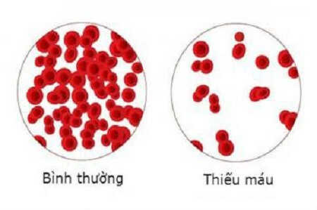 Thiếu máu